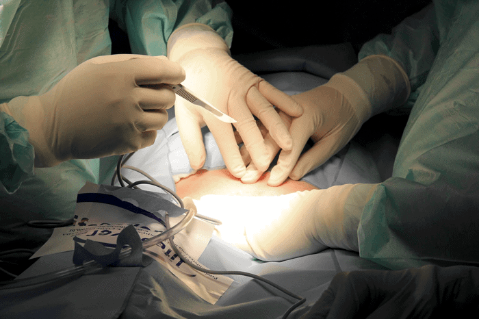 Surgeons about to cut for appendicitis